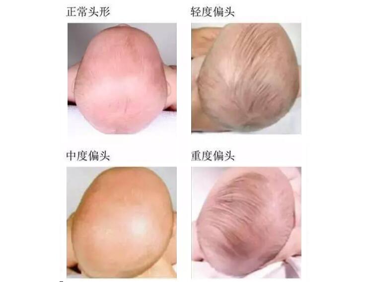 宝宝睡偏头了该如何纠正,如何防止宝宝睡偏头及补救方法