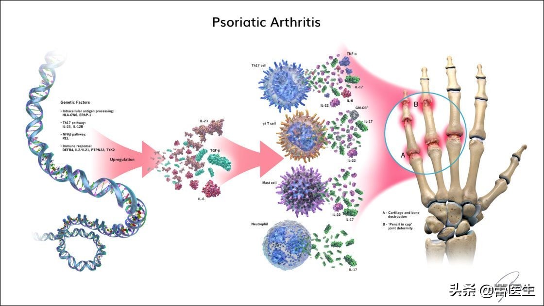 指甲银屑病治疗中会有哪些反应,指甲剥离症会疼吗