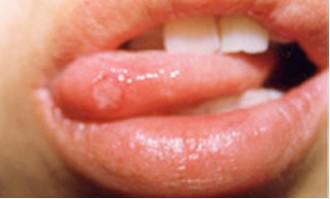 口腔溃疡就一定是“上火”吗？得了口腔溃疡怎么办？