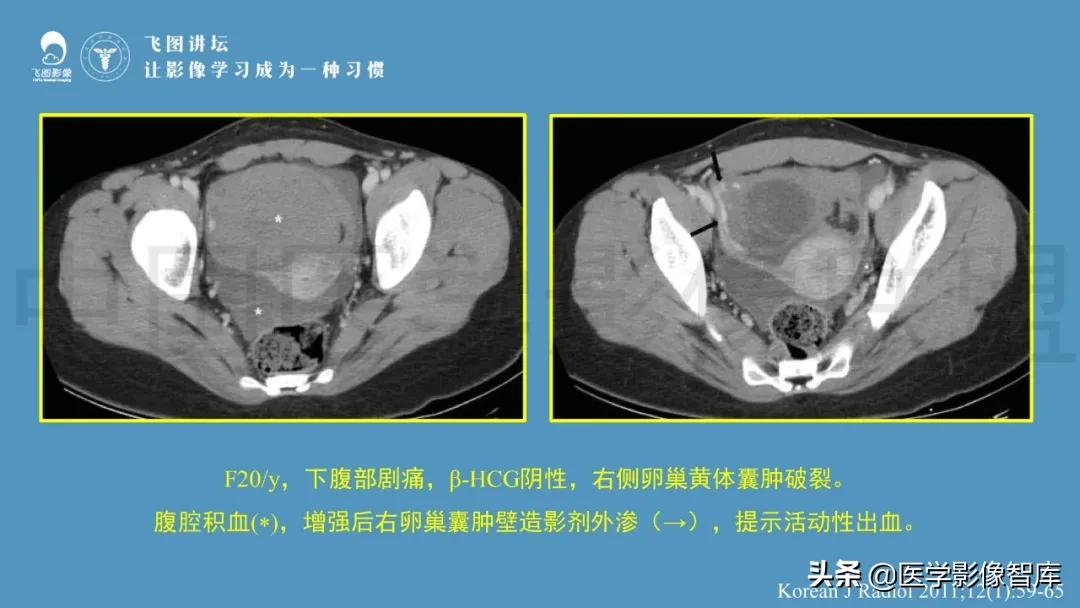 子宫解剖结构输卵管和卵巢位置,子宫附件ct影像学正常解剖表现