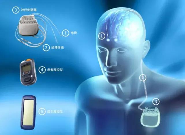 开关现象属于帕金森第几期,帕金森病开关现象指的是什么