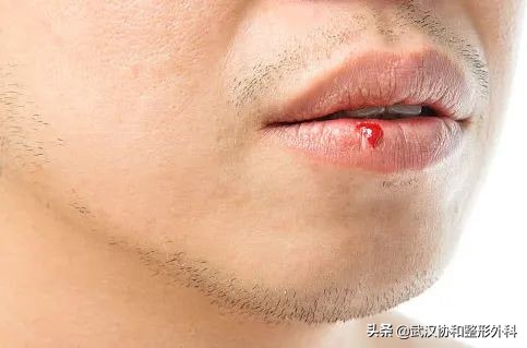 常见的唇部整形都有哪些,常见的唇部整形有哪些