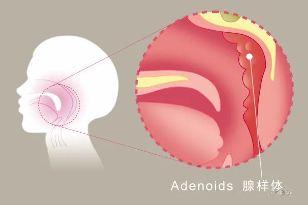 腺样体肥大用艾呼吸有用吗,腺样体肥大如何纠正口呼吸