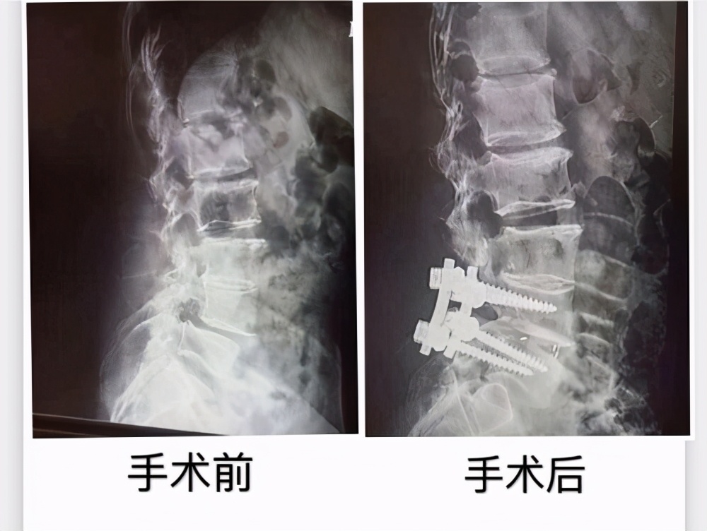 腰椎滑脱症是怎么回事,腰椎滑脱的症状怎么治疗吃啥药