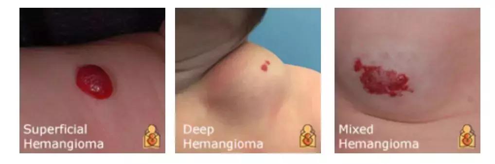 为什么宝宝出生屁股会有青胎记,宝宝出生屁股上有淤青是什么原因