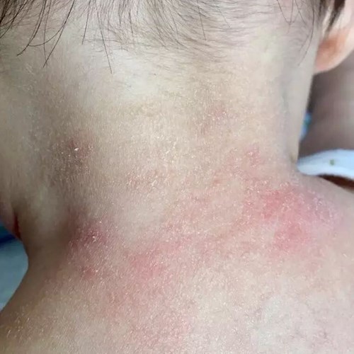 宝宝小疙瘩,宝宝小疙瘩是什么样的