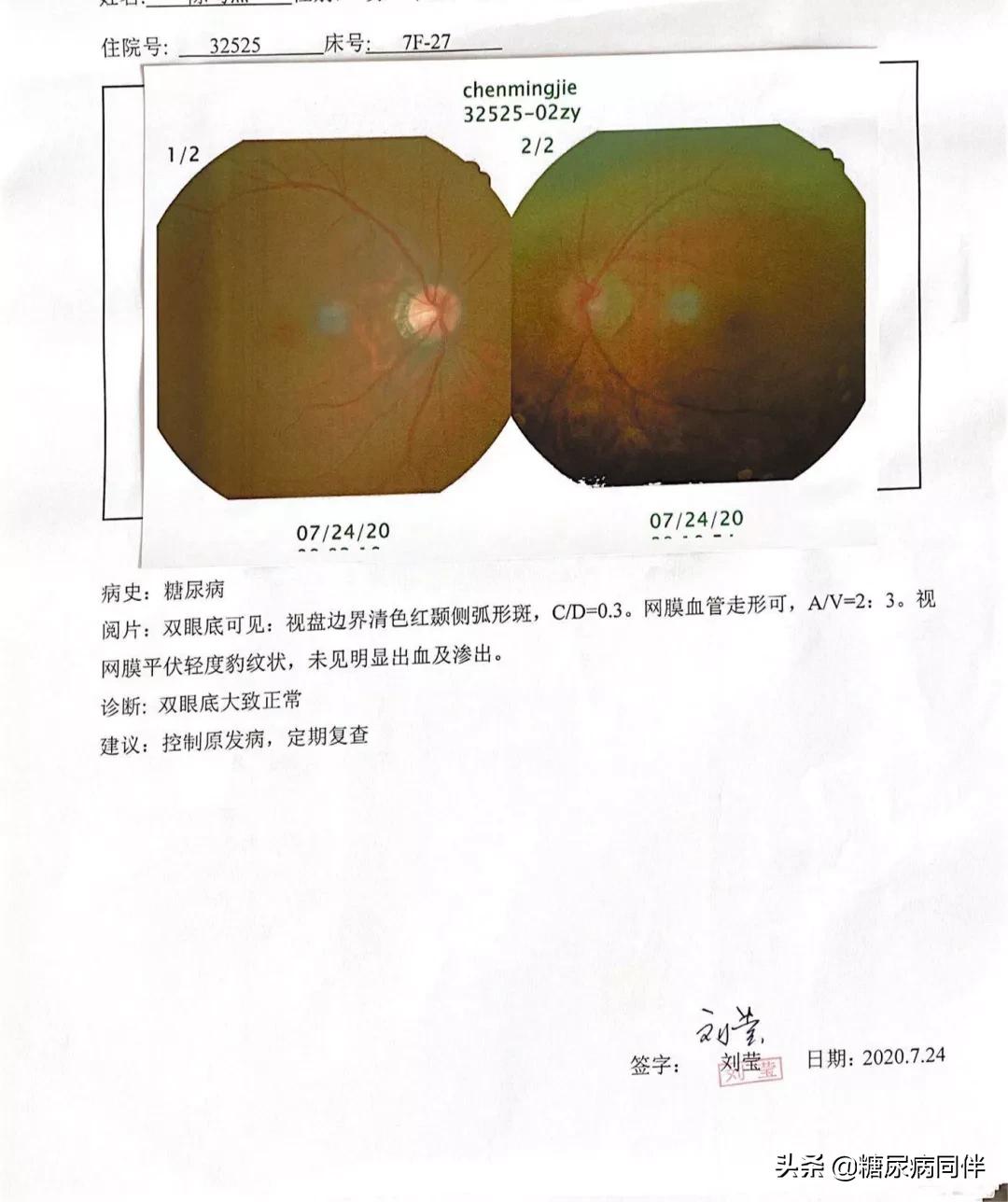 糖尿病新治疗方法逆转,糖尿病的自测与治疗