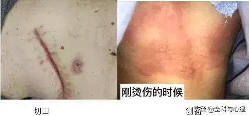 受伤后如何不留下伤疤,受伤留疤怎么去除