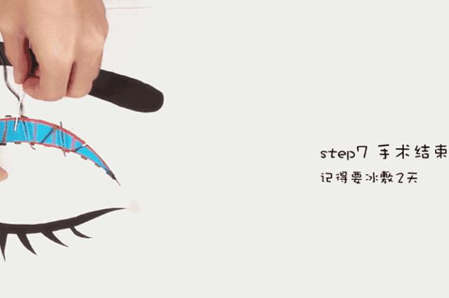 全切无痕割双眼皮,全切双眼皮原来是这么割出来的