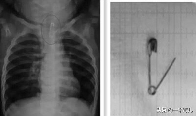 儿童小异物,宝宝吞食异物急救