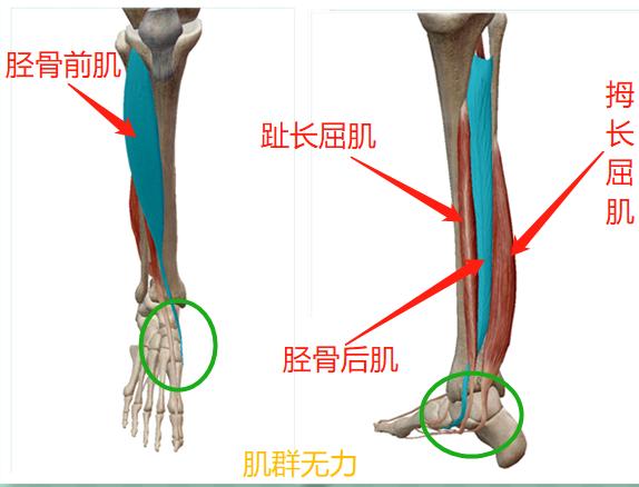 怎么判断小腿肌肉外翻和骨骼弯曲,小腿肌肉外翻和膝盖内扣一样吗
