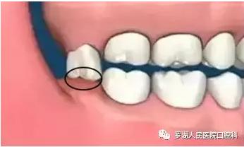 不想拔智齿但很疼怎么办,不想拔智齿想磨掉一部分怎么样