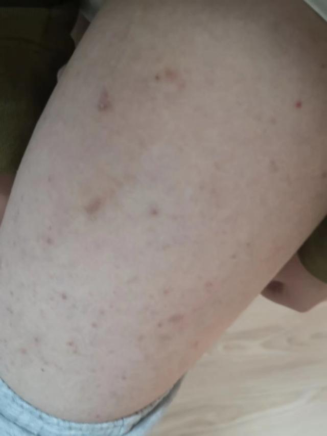 中医治疗皮肤痒的最好方法,中医治疗皮肤纤维瘤