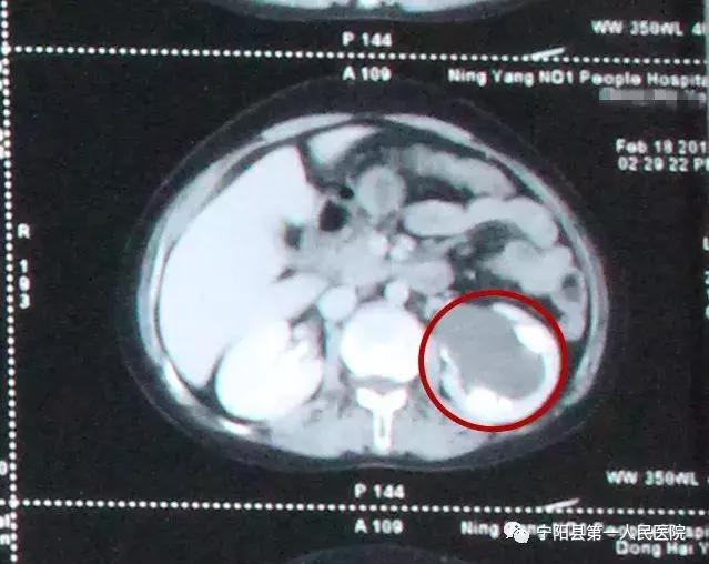 囊肿厉害了需要动手术切除吗,山东哪家医院治疗囊肿好