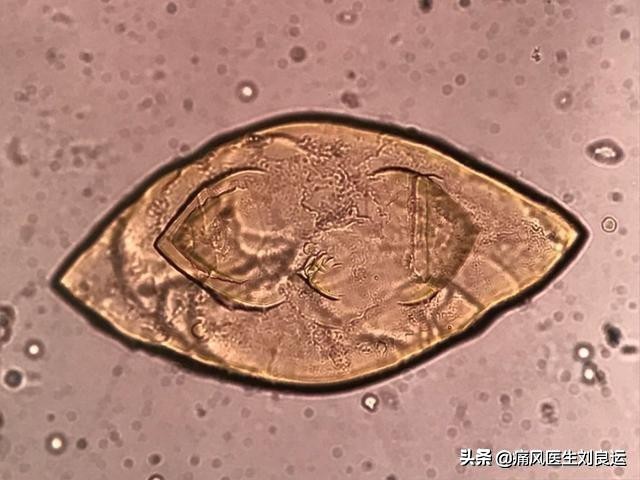 痛风20年长出痛风石，尝试“偏方”险中毒，尿酸高用药有讲究