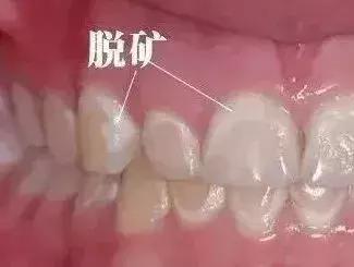 什么是牙齿脱矿原因与疗法你都知道吗？