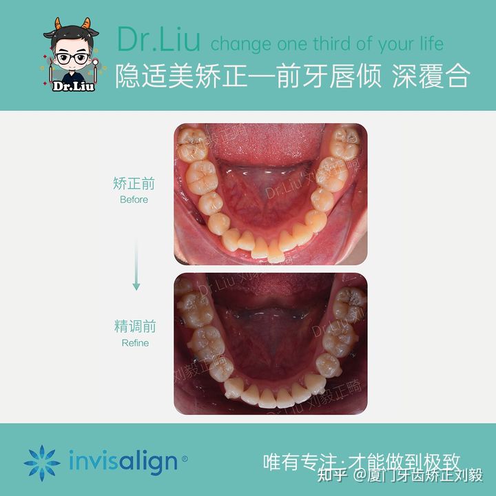 厦门透明牙齿矫正器矫正时间,厦门成人隐形牙齿矫正价格
