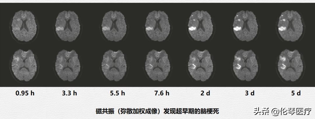 伦琴医疗核心专家王悍教授:脑中风是怎么回事,如何预防与治疗?