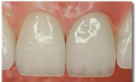 二氧化锆假牙可以做核磁吗,拿不掉的假牙可以做核磁共振么