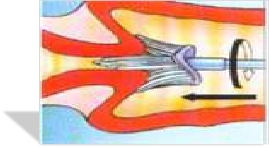 宫颈病变的诊断和治疗,宫颈病变的诊断和治疗华医网