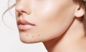 下巴长痘痘祛痘精华,下巴频繁长痘痘的正确消除方法