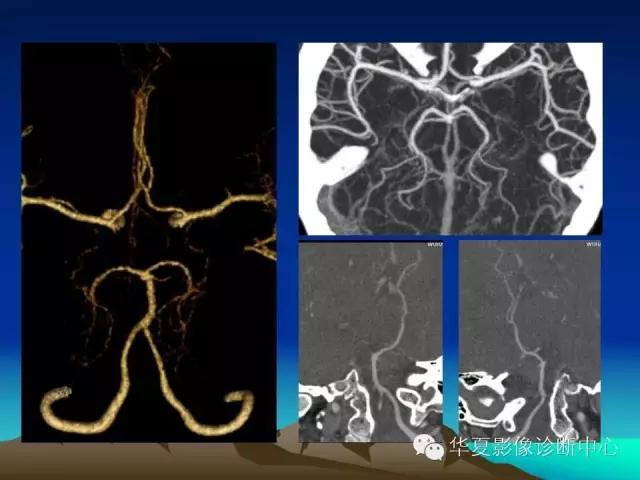小脑血管解剖分段,脑血管影像解剖讲解