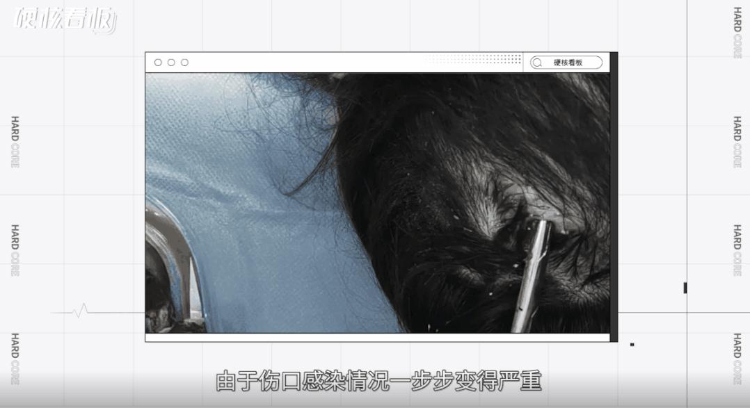 划开头皮、切断肌肉,为了美她们能做到什么程度?