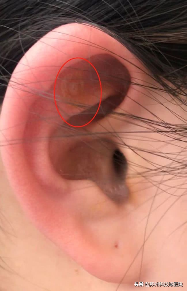 扎耳朵减肥效果好吗,耳针可以帮助减肥吗