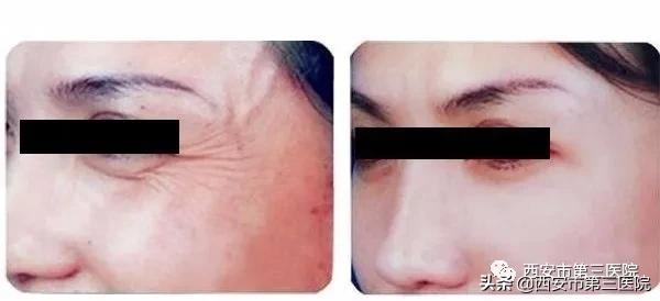 肉毒素能美白皮肤吗,肉毒素在医学美容的作用