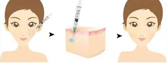 法令纹苹果肌下垂有什么办法改善,如何改善法令纹和苹果肌下垂