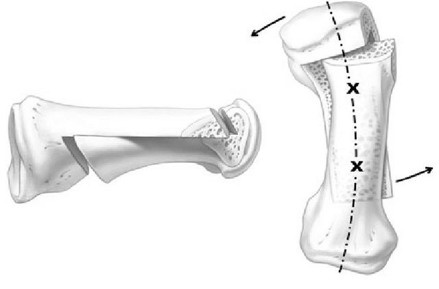 拇外翻大脚趾疼如何在家就能治,大脚拇指痛要警惕