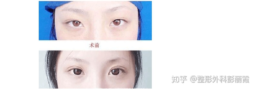 做双眼皮手术自己能看到全过程吗,全切双眼皮修复需要再次切开吗