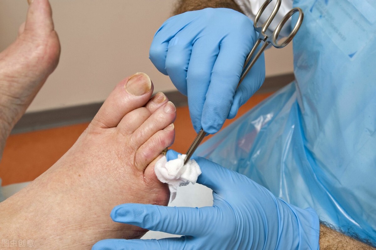 糖尿病烂脚会危及生命吗,糖尿病引起的脉管炎烂脚用什么药