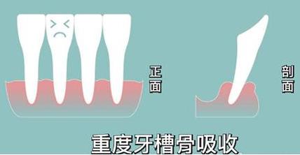 想去种牙,医生却说种不了?看看这位过来人经历了什么