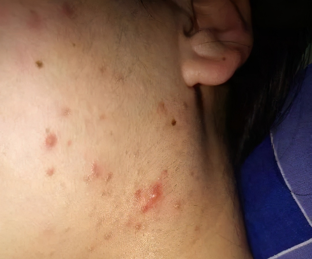 皮肤科医生最喜欢的痘痘