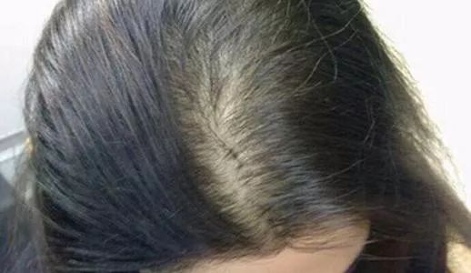 脾虚导致前额脱发,头顶脱发与脾虚有关系吗