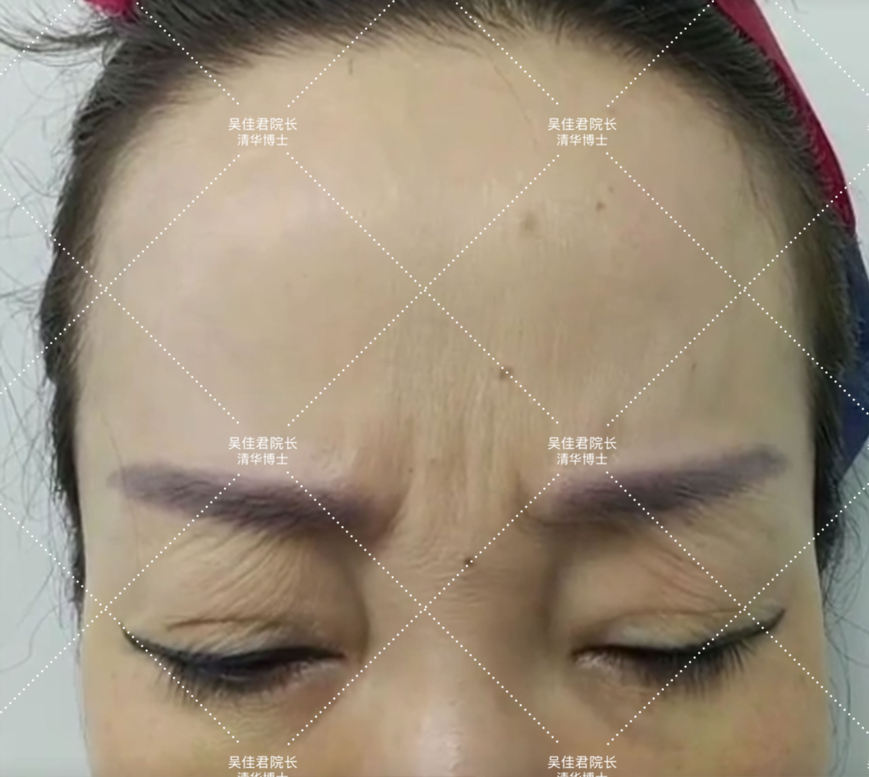 小切口拉皮除皱术适合额头除皱吗,额头缩小大拉皮手术恢复过程