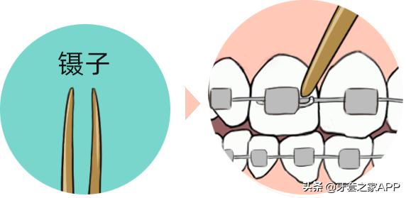 疫情时牙套遇到突发情况怎么办？应对办法在这里