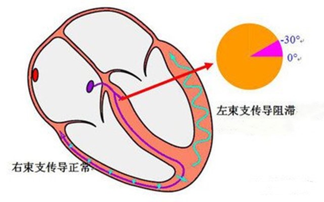 心脏完全性左束支传导阻滞危险吗,完全性左束支传导阻滞是心脏病吗