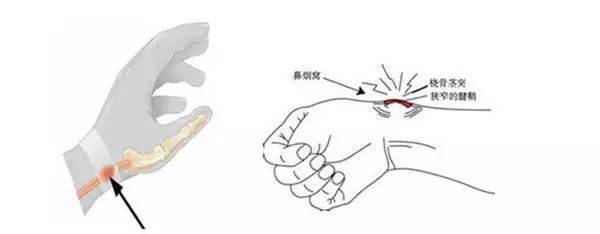 几个动作预防腱鞘炎(妈妈手),准妈妈必看