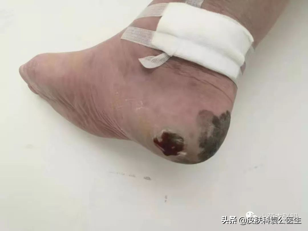 边缘不整齐的痣都是黑色素瘤吗,痣突然变大不规则一定是黑色素瘤