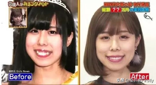 下颌骨缩小整容,下颌骨切除整容