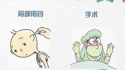 分泌性中耳炎的科普,分泌性中耳炎需要注意什么