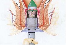 直肠癌手指能摸到肿块吗,直肠癌用手指能摸到吗