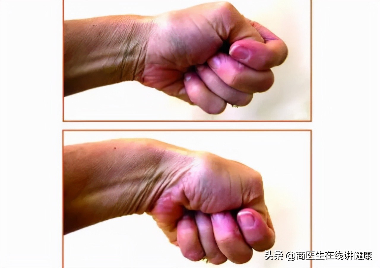 更年期女性为什么会得腱鞘炎,女性腱鞘炎怎么治疗效果最好