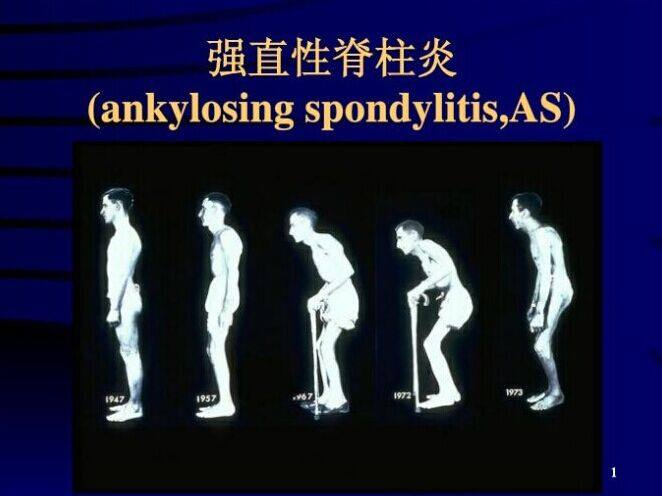 强直性脊柱炎有没有医疗终结一说,强直性脊柱炎AS