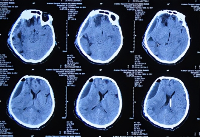 脑外伤开颅手术后脑积水,脑外伤手术后脑脊液鼻漏怎么治疗