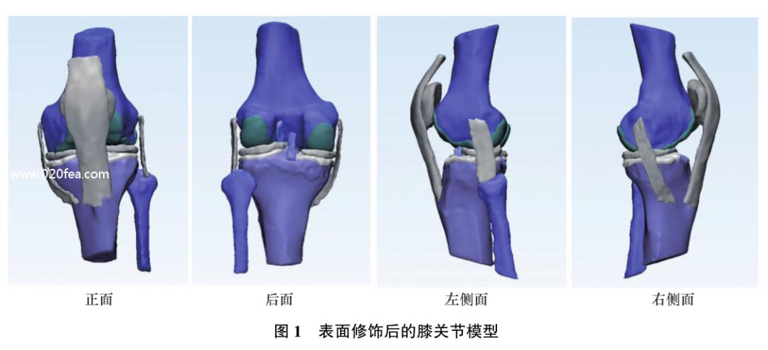 半月板后角二度真实模型,内侧半月板后角结构图