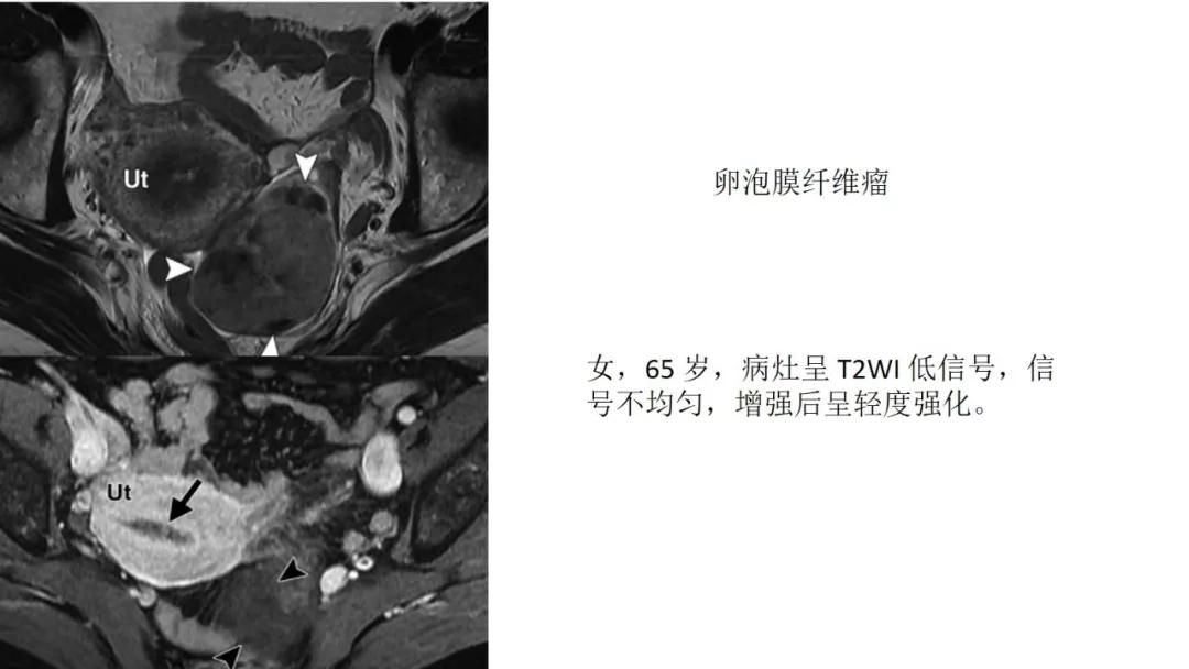 卵巢原发肿瘤的分析思路