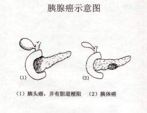中老年人突然腰背疼,老年人腰胀痛要警惕四种原因